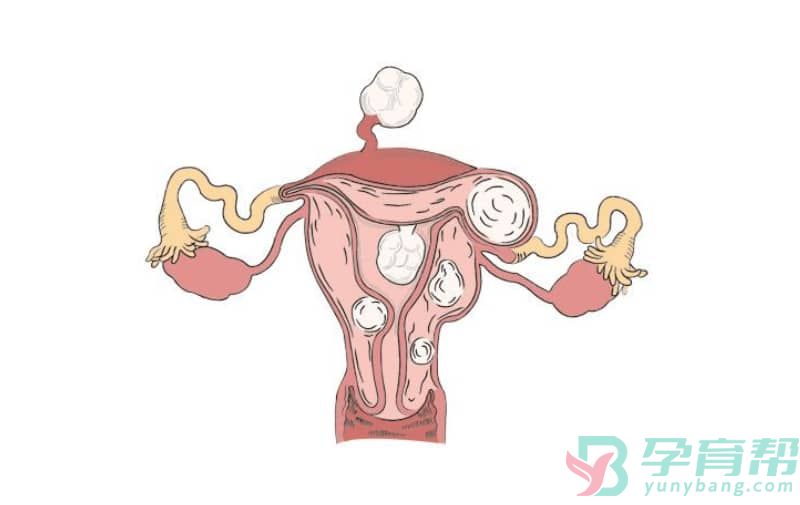 多囊卵巢备孕需要注意些什么事项
