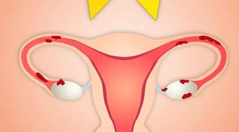 有正常卵巢无子宫的石女可以取卵做试管吗？(图1)