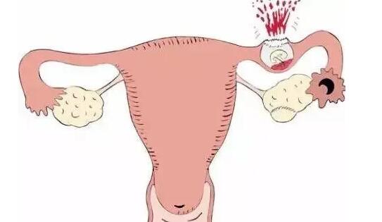 残角子宫可以正常试管怀孕二胎吗？(图1)