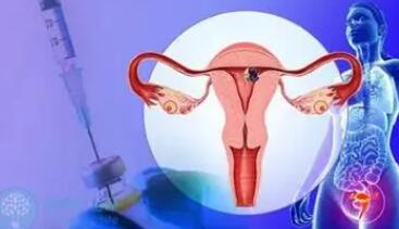 子宫肌瘤试管移植必须做宫腔镜吗多少钱？