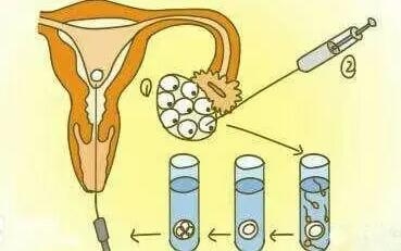 2024输卵管结扎了还可以做试管婴儿吗多少钱？(图1)