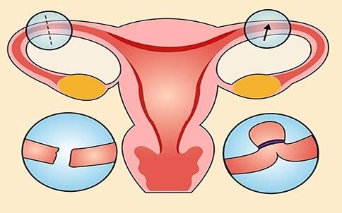 输卵管堵塞做试管需要处理结扎切除吗？(图1)