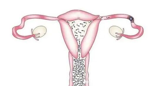 输卵管堵塞做试管能怀孕吗女性成功率多少？