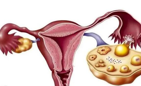多囊卵巢做试管适合什么方案促排卵？