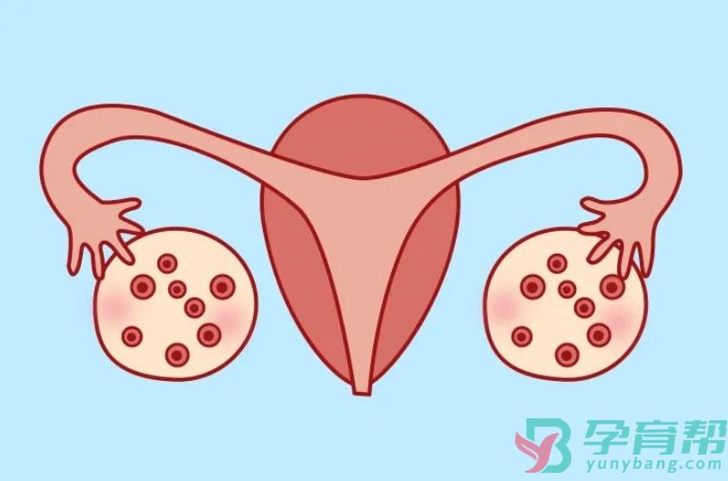 多囊卵巢综合症能怀孕吗(图1)