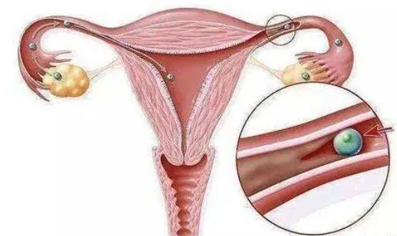 输卵管结核怎么确诊能做试管生育吗？(图1)