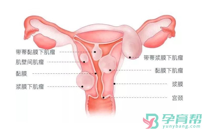 子宫肌瘤多大需要手术(图1)